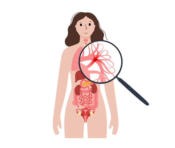 Lungemboli Sjukdom Djup Ventrombos Den Kvinnliga Kroppen Blodpropp Lungvenen Anatomisk — Stock vektor