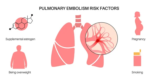 Pulmoner Embolizm Risk Faktörleri Derin Ven Trombozu Hastalığı Akciğer Damar — Stok Vektör