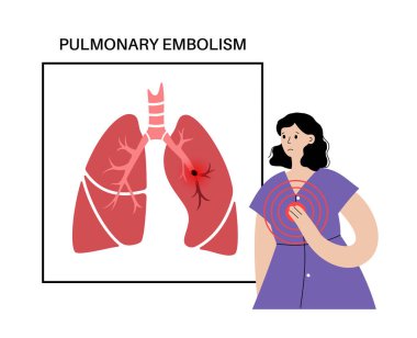 Akciğer embolisi hastalığı. Kadın karikatür vücudunda derin ven trombozu. Akciğer damar anatomik posterinde kan pıhtısı. Ciğerlerdeki kan akışını engelliyor. Dolaşım sistemi sorunu. DVT vektör illüstrasyonu