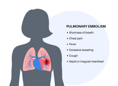 Akciğer embolisi belirtileri. Derin ven trombozu hastalığı. Akciğer damar anatomik posterinde kan pıhtısı. Ciğerlerdeki kan akışını engelliyor. Dolaşım sistemi sorunu. DVT tıbbi düz vektör çizimi.