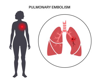 Akciğer embolisi hastalığı. Kadın vücudunda derin damar trombozu. Akciğer damar anatomik posterinde kan pıhtısı. Ciğerlerdeki kan akışını engelliyor. Dolaşım sistemi sorunu. DVT düz vektör çizimi