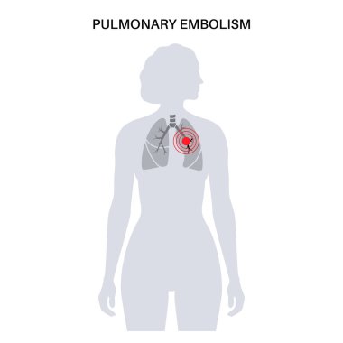 Akciğer embolisi hastalığı. Kadın vücudunda derin damar trombozu. Akciğer damar anatomik posterinde kan pıhtısı. Ciğerlerdeki kan akışını engelliyor. Dolaşım sistemi sorunu. DVT düz vektör çizimi
