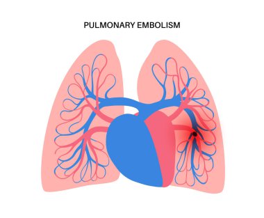 Akciğer embolisi hastalığı. Derin ven trombozu. Akciğer damarlarındaki kan pıhtısı anatomik posteri kapatıyor. Ciğerlerdeki kan akışını engelliyor. Dolaşım sistemi sorunu. DVT tıbbi düz vektör çizimi