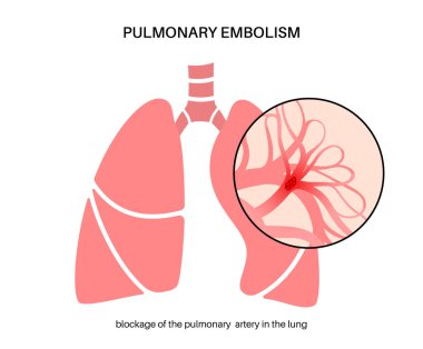 Akciğer embolisi hastalığı. Derin ven trombozu. Akciğer damarlarındaki kan pıhtısı anatomik posteri kapatıyor. Ciğerlerdeki kan akışını engelliyor. Dolaşım sistemi sorunu. DVT tıbbi düz vektör çizimi