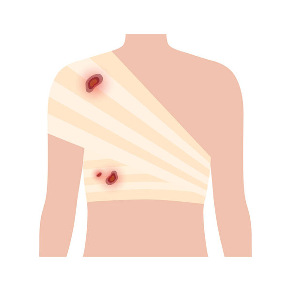 Sore, cut or ulcer on shoulder. Elastic bandage, medical gauze wrapping over a human body. Broken or injured bones. Healthcare concept. First help in a clinic. Patient with trauma vector illustration.