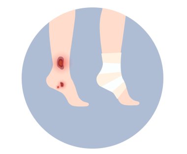 İnsan bacağında yara, kesik ya da ülser. Elastik bandaj, tıbbi gazlı bezi ayağının üzerine sar. Sağlık sigortası konsepti. Klinikte ya da hastanede yaralı bileğe ilk yardım. Travma düz vektör çizimi olan hasta