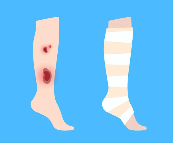 Elastic Bandage Human Leg Roll Wrap Medical Gauze Foot Broken — Stockvector