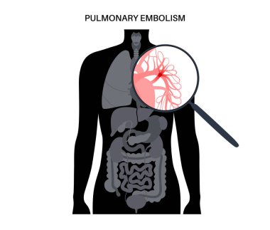 Akciğer embolisi hastalığı. İnsan vücudunda derin ven trombozu. Akciğer damar anatomik posterinde kan pıhtısı. Ciğerlerdeki kan akışını engelliyor. Dolaşım sistemi sorunu. DVT tıbbi vektör çizimi
