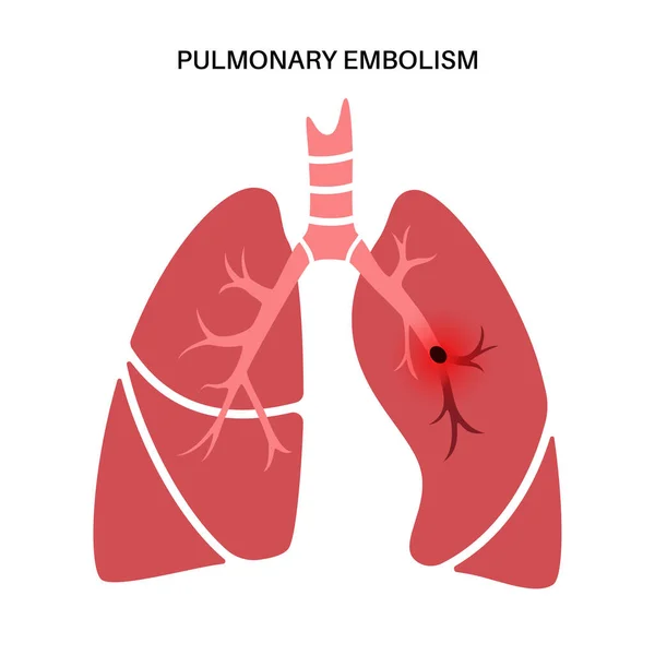 肺塞栓症の病気 深部静脈血栓症 肺静脈の血栓は解剖学的ポスターを閉じます 肺の血流を遮断する 循環系の問題 Dvt医療フラットベクトルイラスト — ストックベクタ