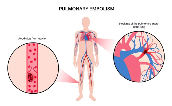 Pulmonary Embolism Disease Deep Vein Thrombosis Male Body Blood Clot — 图库矢量图片