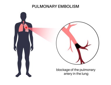 Pulmonary embolism disease. Deep vein thrombosis in male body. Blood clot in lung vein anatomical poster. Blocking blood flow in lungs. Circulatory system problem. DVT medical flat vector illustration