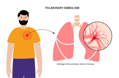 Akciğer embolisi hastalığı. Erkek karikatür vücudunda derin ven trombozu. Akciğer damar anatomik posterinde kan pıhtısı. Ciğerlerdeki kan akışını engelliyor. Dolaşım sistemi sorunu. DVT vektör illüstrasyonu