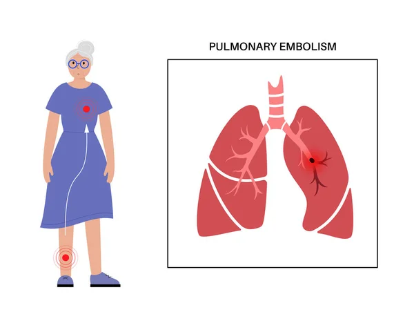 肺塞栓症の病気 女性の成人患者 深部静脈血栓症の老婦人 肺静脈の血栓 肺の血流を遮断する 循環系の問題 Dvtベクターイラスト — ストックベクタ