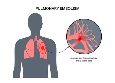 Pulmonary embolism disease. Deep vein thrombosis in male body. Blood clot in lung vein anatomical poster. Blocking blood flow in lungs. Circulatory system problem. DVT medical flat vector illustration