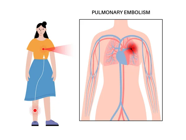 폐활량 색전증 혈전증이요 폐정맥 해부학 포스터에 혈류를 순환계 문제입니다 Dvt — 스톡 벡터