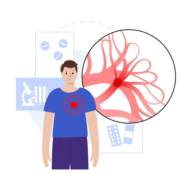 Lungemboli Sjukdom Djup Ventrombos Den Tecknade Manliga Kroppen Blodpropp Lungvenen — Stock vektor