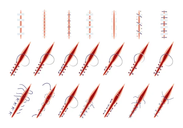Iconos Sutura Conjunto Vector Dibujos Animados Cirugía Heridas Laceración Del — Vector de stock