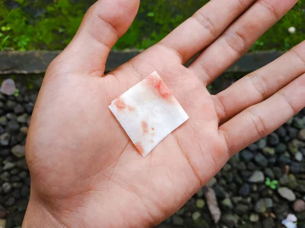 tissues containing blood scars of vaccine injections