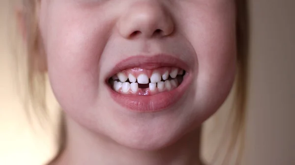 En fyraårig flicka hade mjölktänder. Närbild av flickornas tänder. Förlust av mjölktänder. Ersättning av permanenta tänder. Pediatrisk tandvård. Royaltyfria Stockbilder