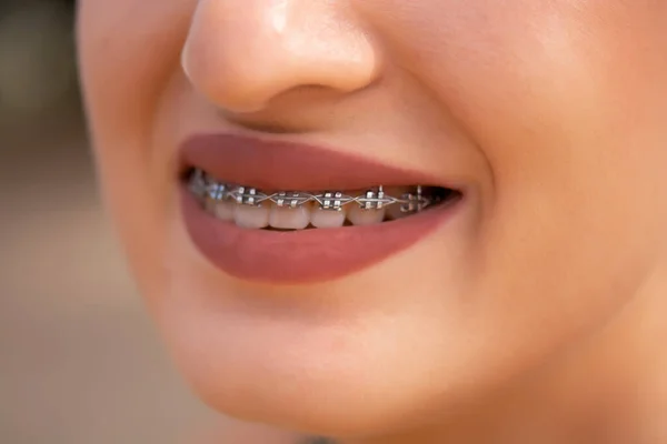close-up smile with braces, smiling girl, close-up smile, wearing braces, dentistry, healthy teeth concept, cleaning braces