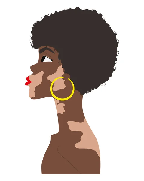 african woman with vitiligo. woman with spots problem on the skin