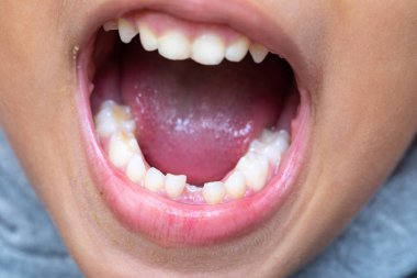 Orta dişleri dökülmüş, ağzı açık bir çocuk çenesi. Diş çıkarma süreci bebeklerin konseptini etkiler
