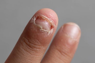 Makro görüş tek parmak tırnağı enfeksiyondan zarar görmüş. Onikomikozis hasarlı tırnaklar konsepti