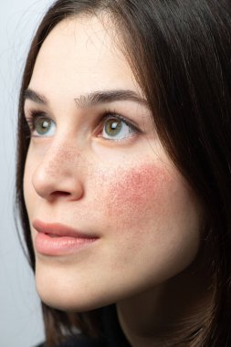 Kırmızı yanaklı, akneiform rosacea 'dan muzdarip genç bir kadının yüzü. Cilt kızarıklığına neden olan dermatolojik sorun