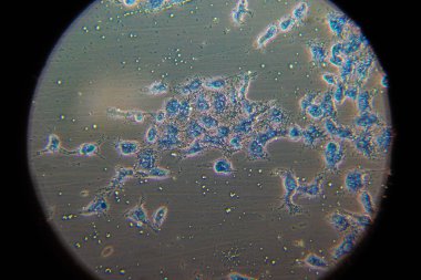 Yukarıdan aşağıya mikroskobik manzara mikroskopla küçük oluşumlar. Bir tabakta insan kanser hücreleri.