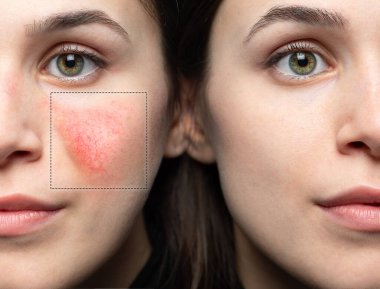 Lazer tedavisinden önce ve sonra Rosacea veya couperose. Kafkasyalı genç bir kadının suratından başarılı bir tasfiye.