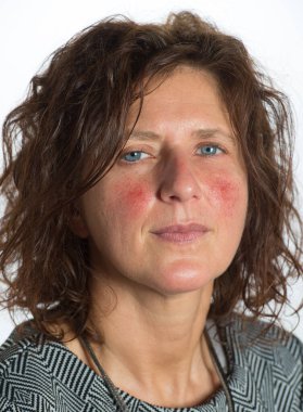 Kılcal damarların genişlemesinden dolayı kırmızı yanaklı genç bayan, ayrıca couperose olarak da bilinir. Dermatolojik sorun, tedavi edilmesi zor cilt sorunlarına neden olur.