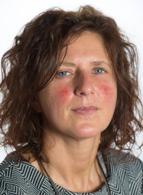 Young lady with red cheeks due to dilation of the capillaries due to rosacea, also called couperose. Dermatological problem that causes skin problems that are difficult to treat clipart
