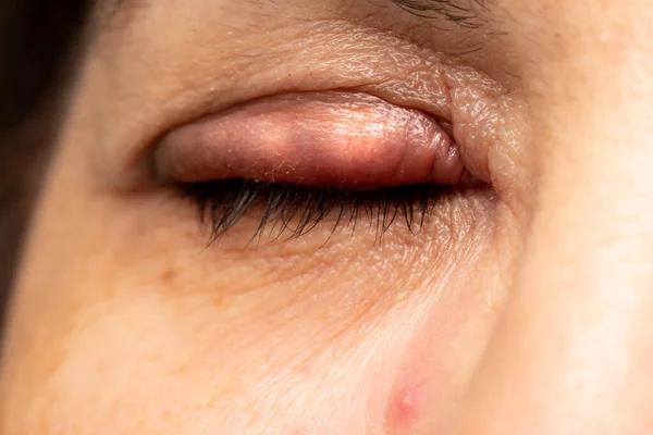 Woman Eye Stye Her Eyelid Swollen Eye Eyelid Which Appears — Stock Photo, Image