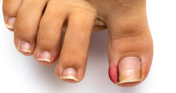 Macro of a lady\'s big toe with ingrown toenail. Red and swollen skin due to skin inflammation and underlying push. Need for medical surgery