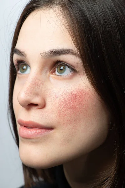 Kırmızı yanaklı, akneiform rosacea 'dan muzdarip genç bir kadının yüzü. Cilt kızarıklığına neden olan dermatolojik sorun