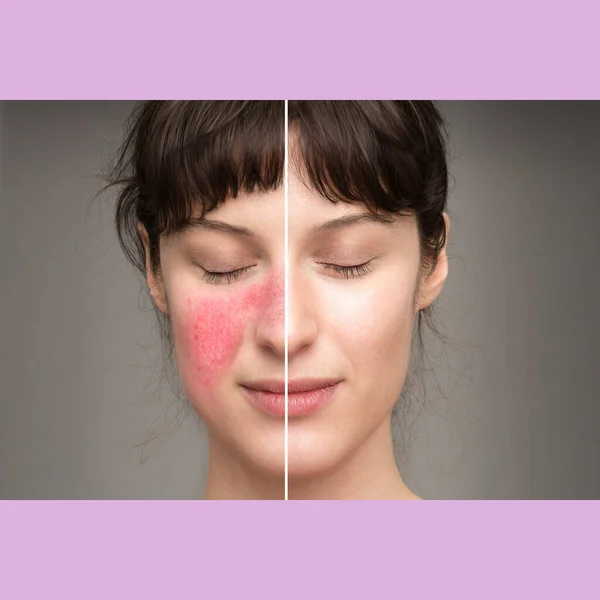 Signs Symptoms Rosacea Natural Cures Treatment Skin Disorders Couperose Laser — Stock Photo, Image
