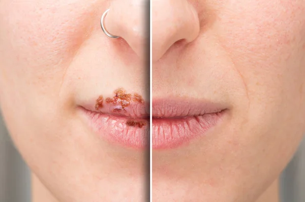 Primo Piano Delle Labbra Una Donna Prima Dopo Trattamento Herpes — Foto Stock