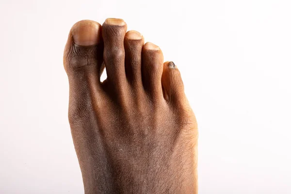 Kaukasische Füße Mit Spitzen Schmutzigen Und Hässlichen Fußnägeln Und Faltiger — Stockfoto