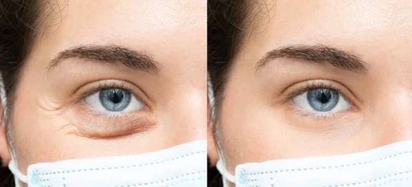 Antes Depois Tratamento Envelhecimento Contra Sacos Sob Olhos Remoção Olheiras — Fotografia de Stock
