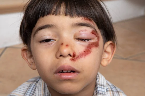 Niño Con Moretones Cara Ojos Hinchados Magullados Concepto Violencia Infantil — Foto de Stock
