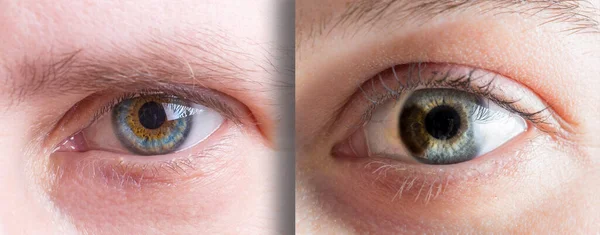 Dois Casos Diferentes Heterocromia Olho Duas Mulheres Macro Azul Marrom — Fotografia de Stock