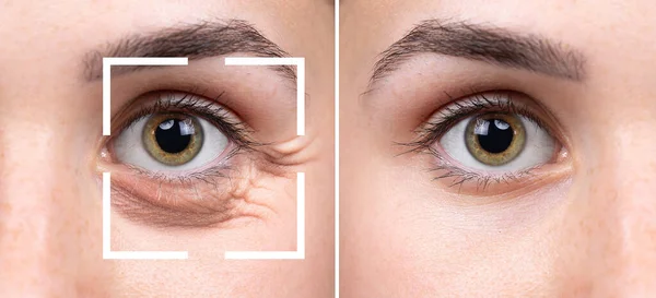 Collage Closeup Views Women Eyes Comparison Beauty Care Intervention Wrinkles — Stock Photo, Image