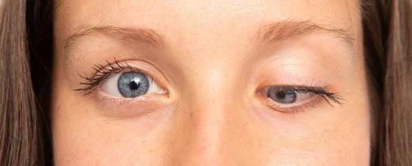 ドロピーとしたまぶたとスネを持つ少女の目のマクロ 浮腫まぶた症候群 — ストック写真
