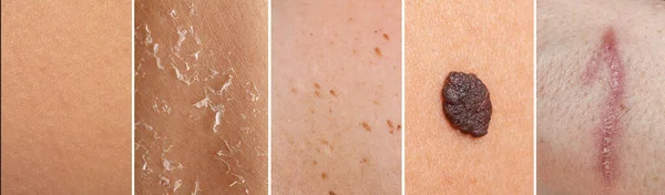 Collage of various rectangles of human skin with different issues. Composition with normal, dry, blemished and scarred skin and skin with a mole