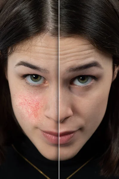 Successful Rosacea Treatment Face Caucasian Lady Redness Visible Blood Vessels — Stock Photo, Image