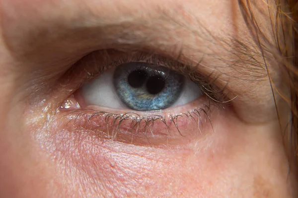 Macro of a woman\'s blue eye with polycoria, doubling of the pupil. Rare case of eye with two pupils