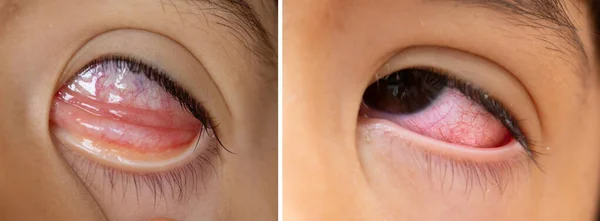 Makro Eines Sehr Roten Auges Mit Orientalischen Merkmalen Aufgrund Einer — Stockfoto