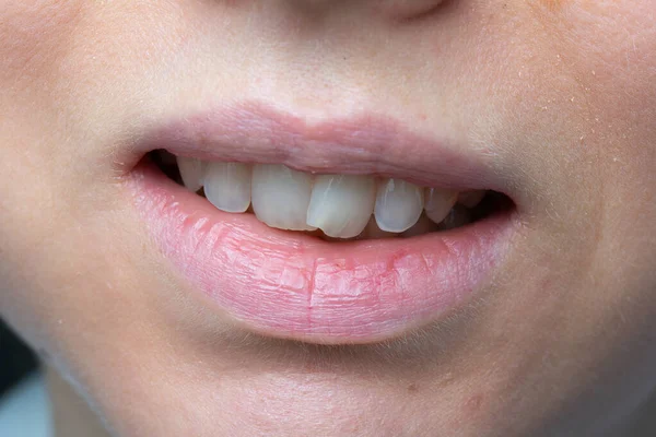 Dişlerin Dişlerin Düzgün Olmayan Yanlış Hizalanmamış Yakın Plan Fotoğrafları — Stok fotoğraf