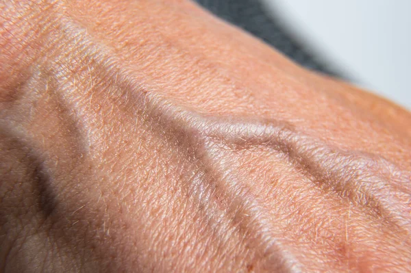 Макрос Жіночої Руки Показує Деталі Виступаючі Вени Концепція Гіпертензії Варикозних — стокове фото