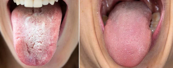 Closeup of woman\'s tongue sticking out of her mouth. Comparison between a healthy tongue and one with candidiasis and bacterial patina. Hygiene and halitosis concept